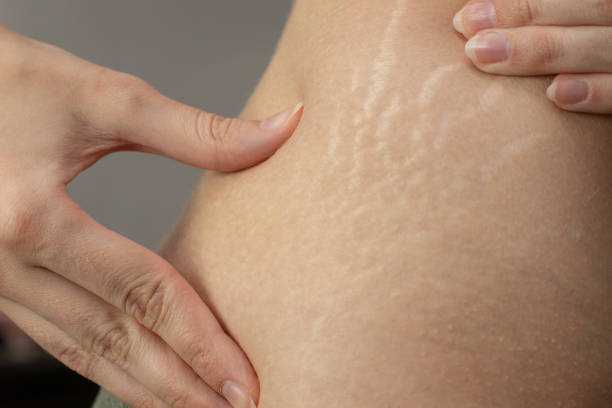 Post Natal Care: How to Get Rid of Stretch Mark